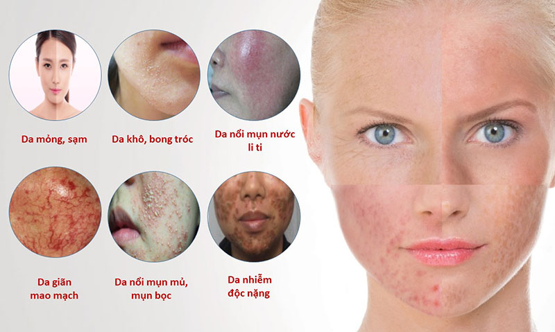 Biểu hiện của người bị viêm da corticoid