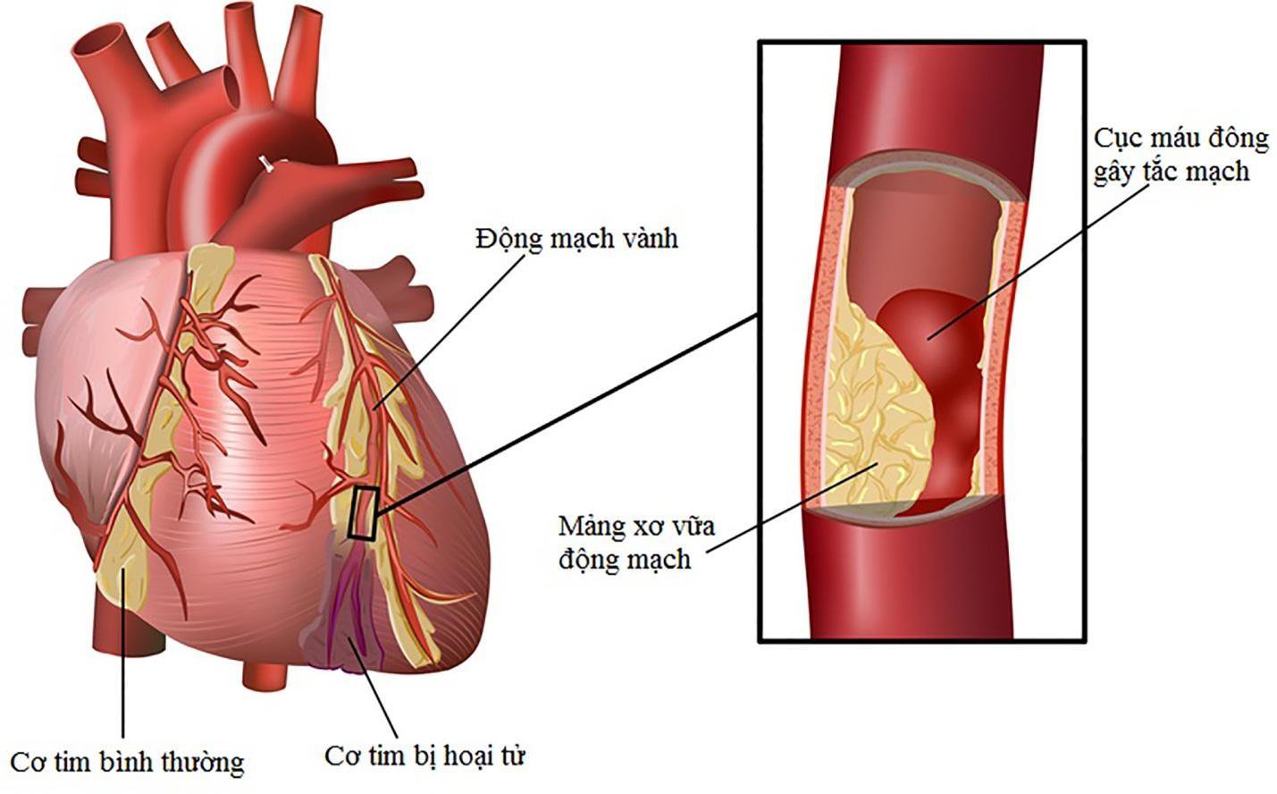 Nhồi máu cơ tim ngày một phổ biến